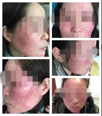 新乡治疗脸部皮肤过敏,脸部皮肤过敏去湛江哪里看好