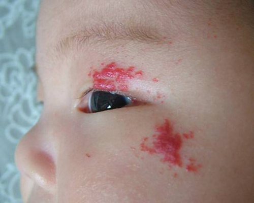 脸上血管瘤怎么引起的,脸上的血管瘤是怎么形成的