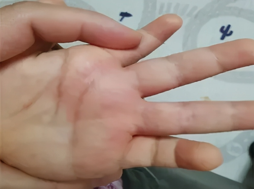 手上长一片小疙瘩还痒是怎么回事,天一热手上就起一层小疙瘩还很痒