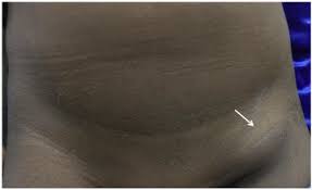 持续性淋巴结肿大综合征特点,隐匿性乳腺癌腋窝淋巴结肿大特点