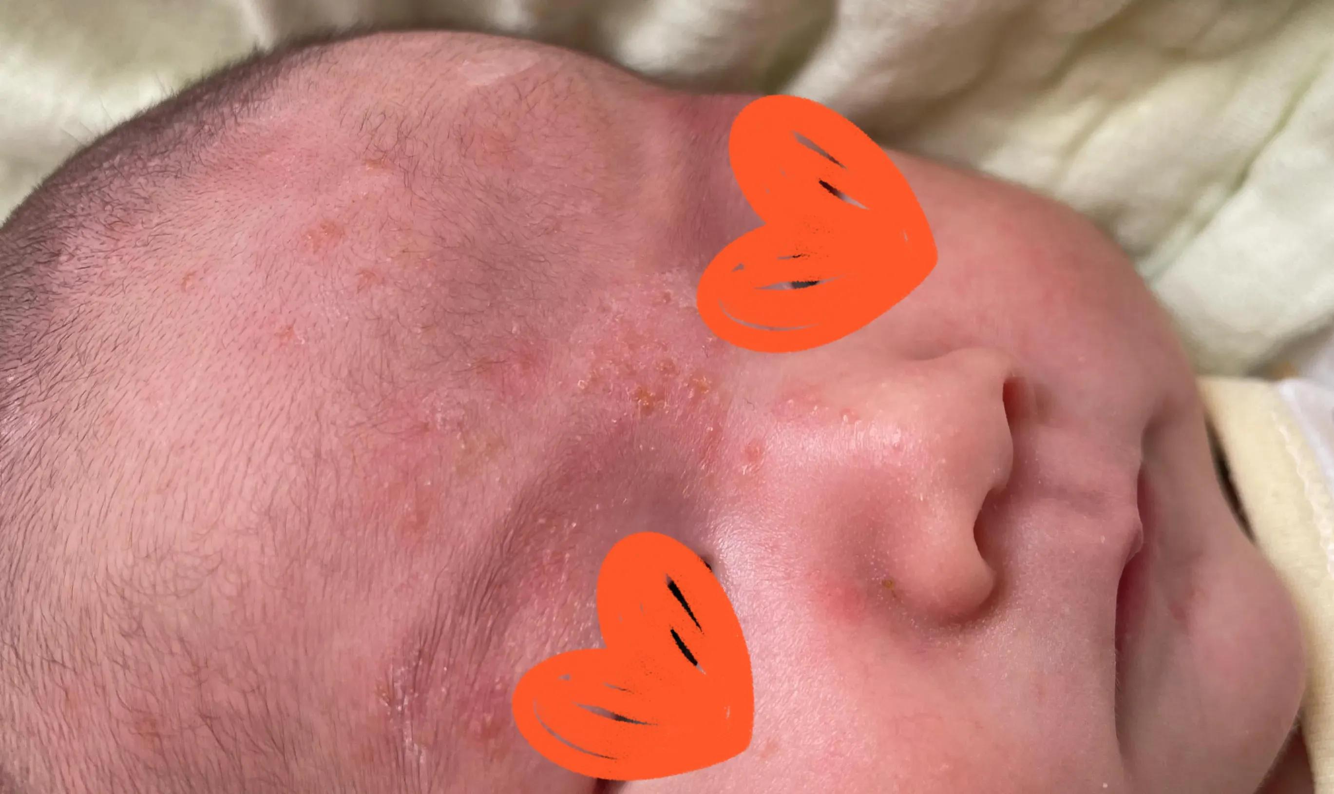 养宠物会不会造成孩子湿疹,宝宝湿疹跟家里养宠物有关系吗