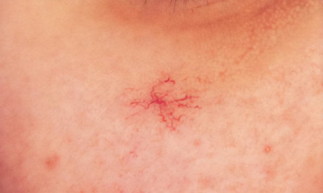 身上突然很多小红痣是什么原因,手臂上长了小红点不痛不痒像痣