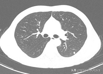 不同类型肺癌的化疗方案,不同类型的肺癌症状区别