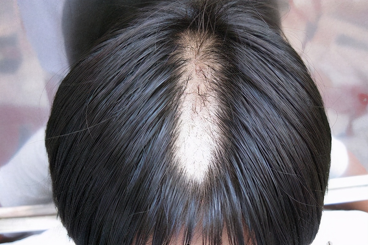 什么是发蛀性脱发,发蛀脱发的意思