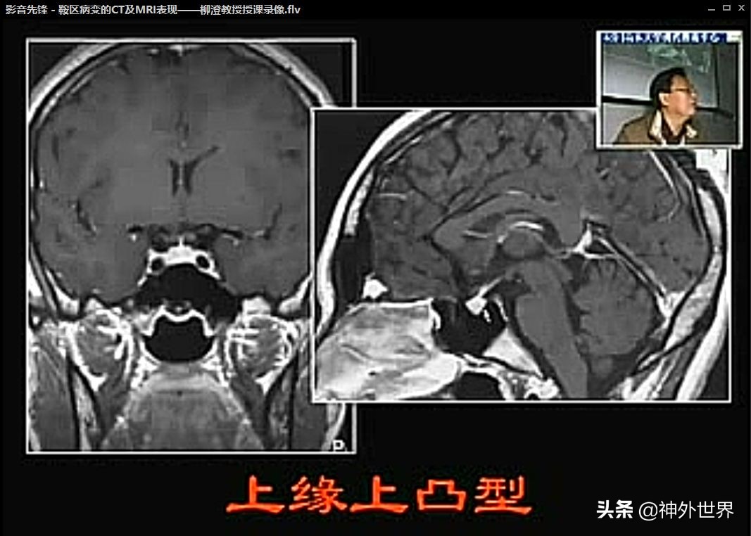 鞍区核磁解剖图,鞍区解剖与手术