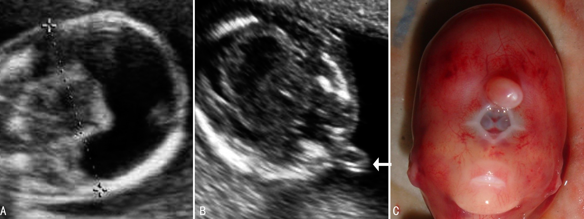 胎儿颅脑结构及心脏结构异常,胎儿颅脑形态及结构异常