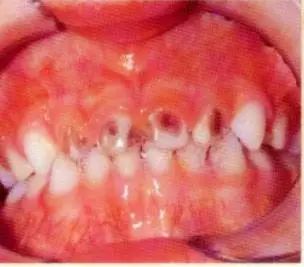 修复一颗蛀牙的全过程,蛀牙早期黑点全治好了的感觉真好