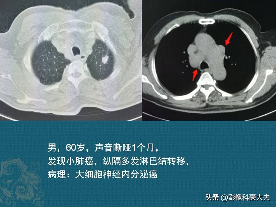 这5种癌一发现就是晚期,第一例癌症患者治愈
