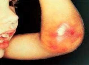 【掌健识】儿童血友病知识(2):血友病的按需治疗