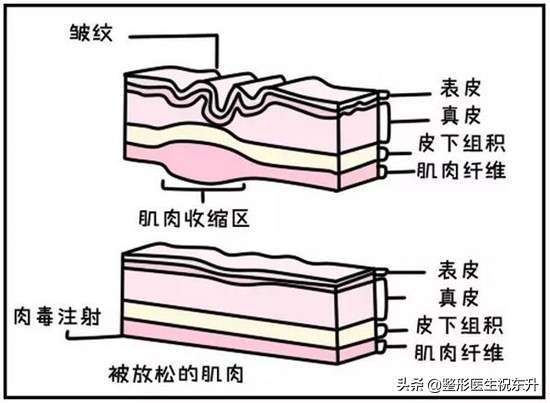 眉间纹很淡打肉毒素打多少,眉间有纹打肉毒素能消除吗