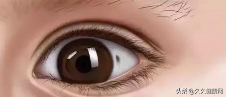 眼白上有黄斑会有什么后果,眼白有黑点是中邪了么