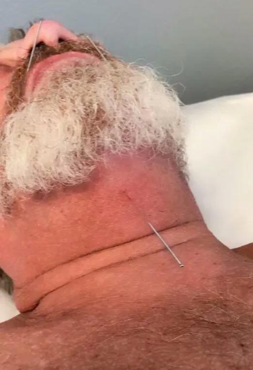 流口水针灸扎几个止涎穴,董氏奇穴治成人流口水