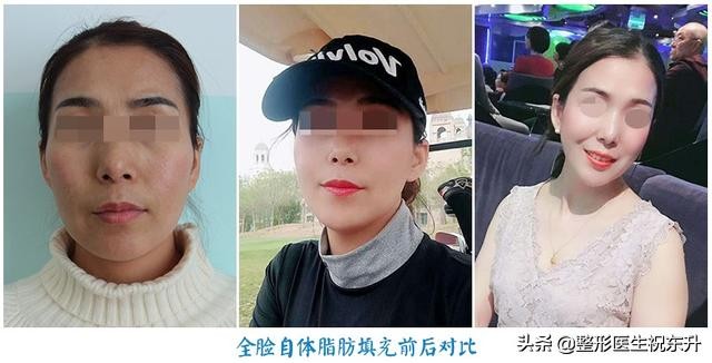 颧骨高太阳穴凹陷额头窄怎么修容,太阳穴凹陷与额头有明显棱角面相