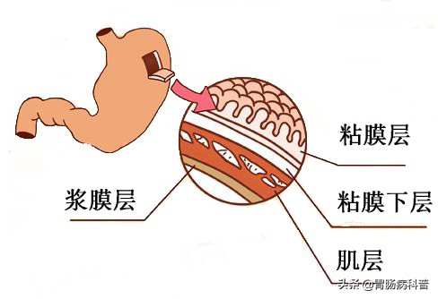 慢性浅表性非萎缩性胃窦炎,浅表性胃炎与慢性非萎缩性的区别