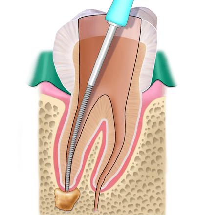 根管治疗会彻底吗,根管治疗真的安全吗