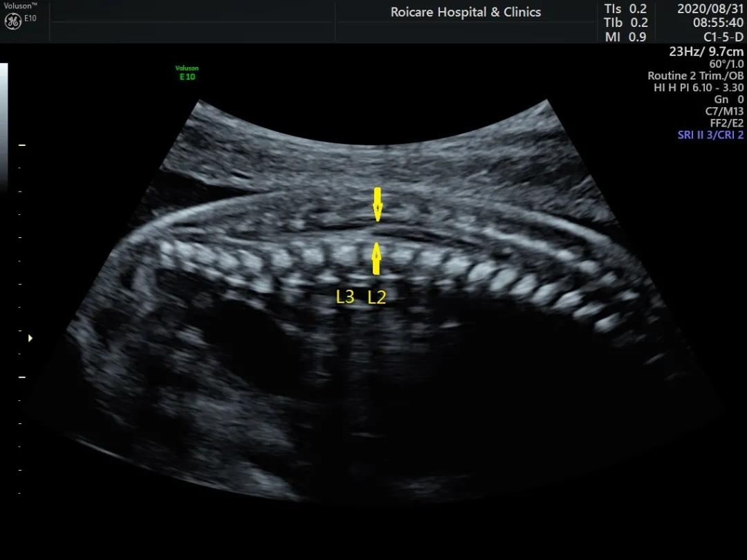 胎儿脊髓圆锥位置低是什么情况,胎儿脊髓圆锥位置偏低做核磁共振