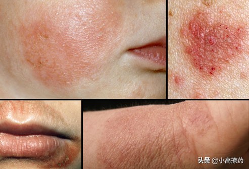 湿疹有哪些药可以治好,湿疹有哪些药