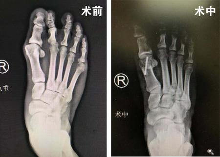 拇外翻全国足踝外科顶级专家,精细化手术