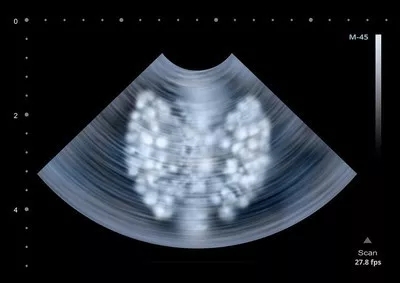 甲状腺癌转移到淋巴和肺能活多久,甲状腺癌转移肺最佳治疗方法