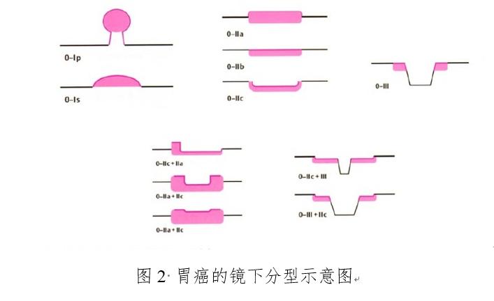 我国胃癌新发人数,2020年我国胃癌新发病例数达多少