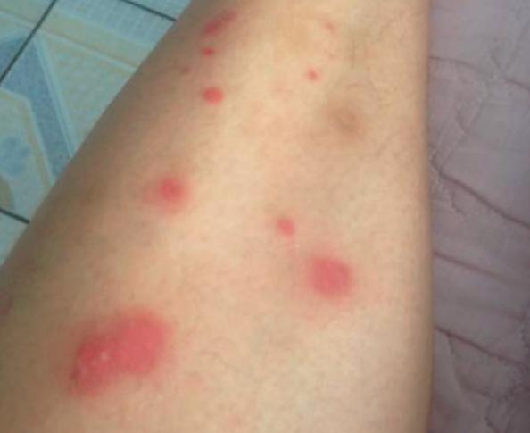 身上若是出现湿疹，多半与这4个原因有关，早知道早好