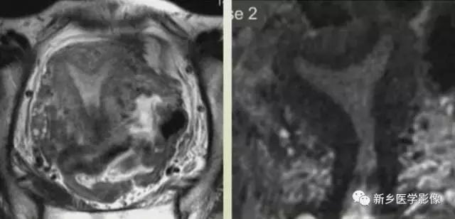 子宫发育异常,应想到的6大类常见畸形