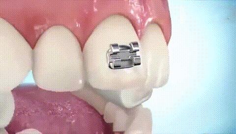 金属牙套戴上牙套后矫正的全过程,矫正牙齿戴牙套的全过程