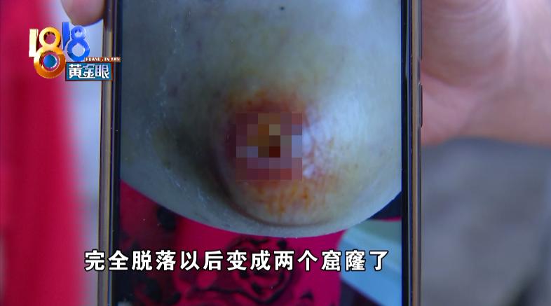 鑲樼毊鐐庢墦浜嗗嚑閽堝悗婧冪儌,鎵嬭倶鐨値娌荤枟