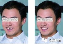 门牙受伤怎么办,门牙撞断了怎么办