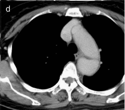 肠系膜上动脉夹层,心脏动脉夹层破裂