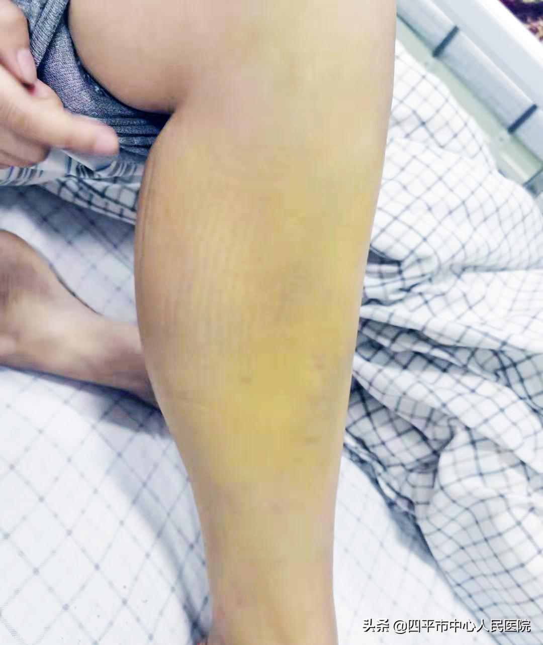 四平中心医院患者,四平第一人民医院血液科