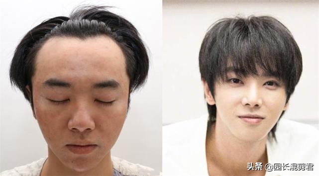 华晨宇回应植发,曝华晨宇植发真的假的