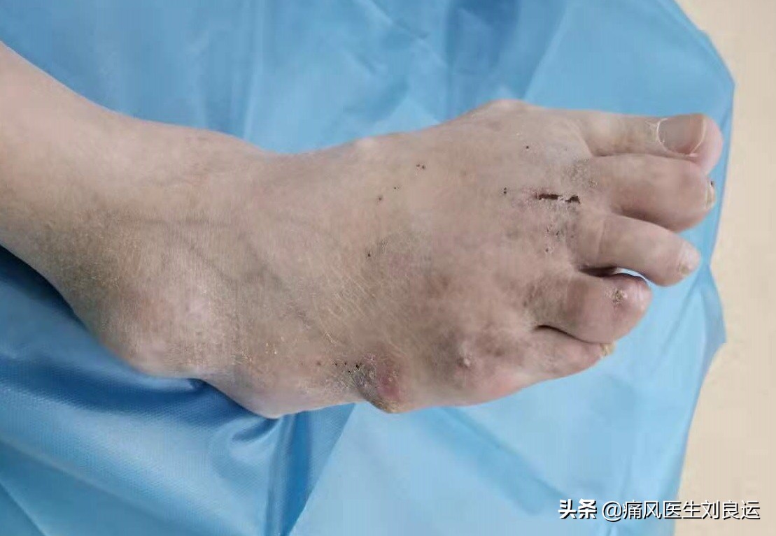 男子扭伤脚后续,原有痛风脚扭伤会诱发痛风吗