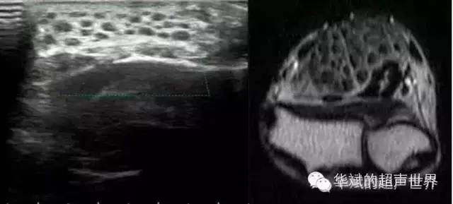 纤维脂肪瘤属于什么类型的疾病,特殊类型脂肪瘤