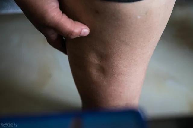 眼肿小腿一按一个坑怎么回事,一条腿肿一按一个坑是怎么回事