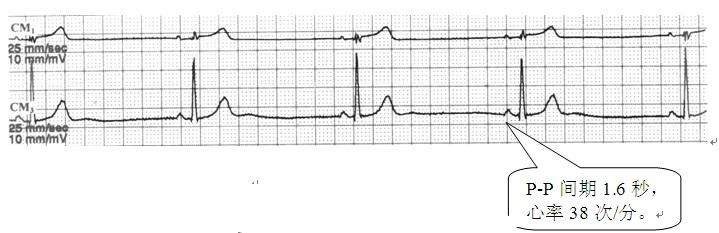 心脏彩超和动态心电图哪个准确,心电图跟心脏彩超哪个更准确