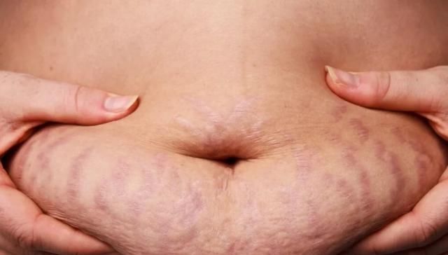 妊娠纹如何修复最好,如何预防以及缓解妊娠纹