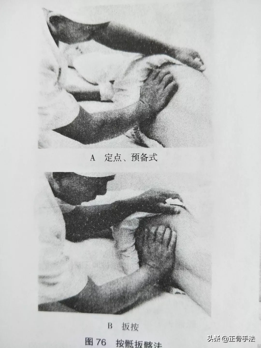 骶尾椎错位正骨手法,骶椎错位怎么复位