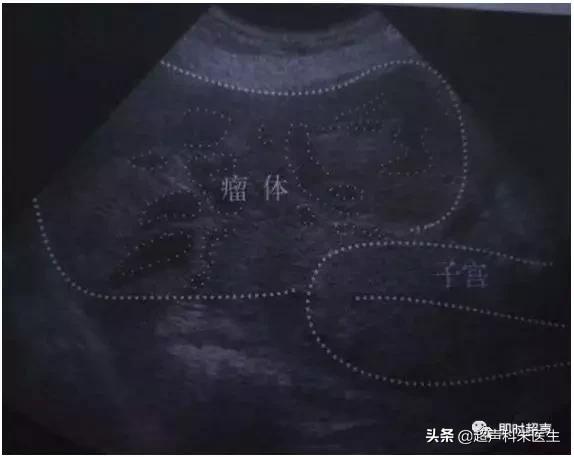 妇科超声的标准超声图,妇科超声图解