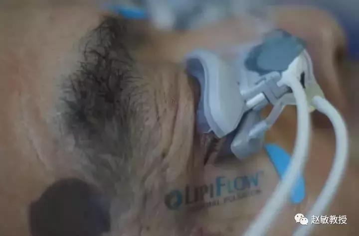 干眼症福音！眼视光眼科干眼治疗新技术