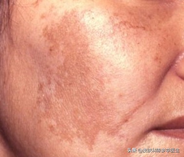 雀斑怎么治效果好能根治吗,雀斑怎么治疗能彻底解决吗