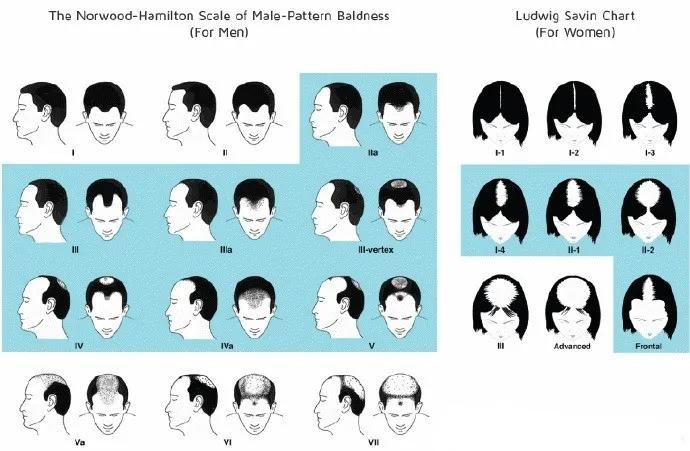 雄秃怎么样算比较严重,雄秃算不算病