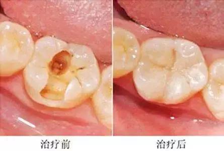 几百块补一个牙是智商税吗,几十块钱的补牙可行吗