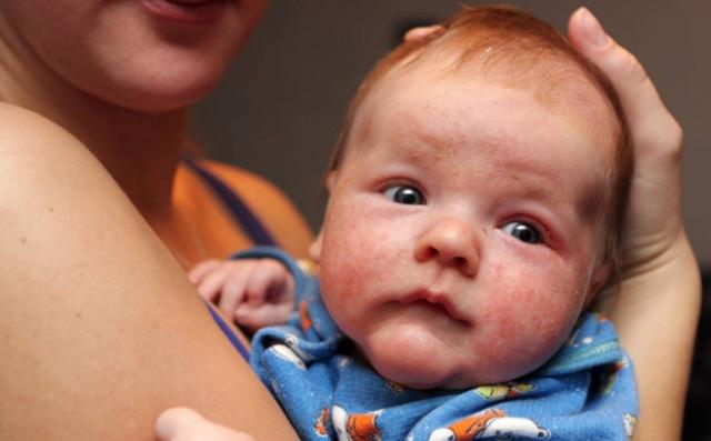 哪些原因会导致小孩得湿疹 (孩子容易得湿疹的原因有哪些)