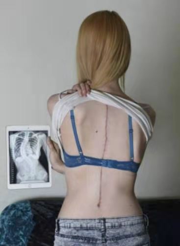 怎么矫正高低肩长短腿,脊柱侧弯高低肩瑜伽体式纠正