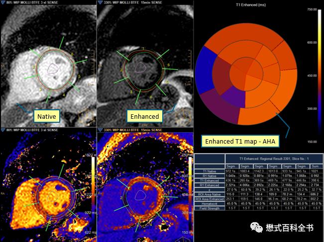心脏磁共振定位方法,心脏磁共振各参数分析