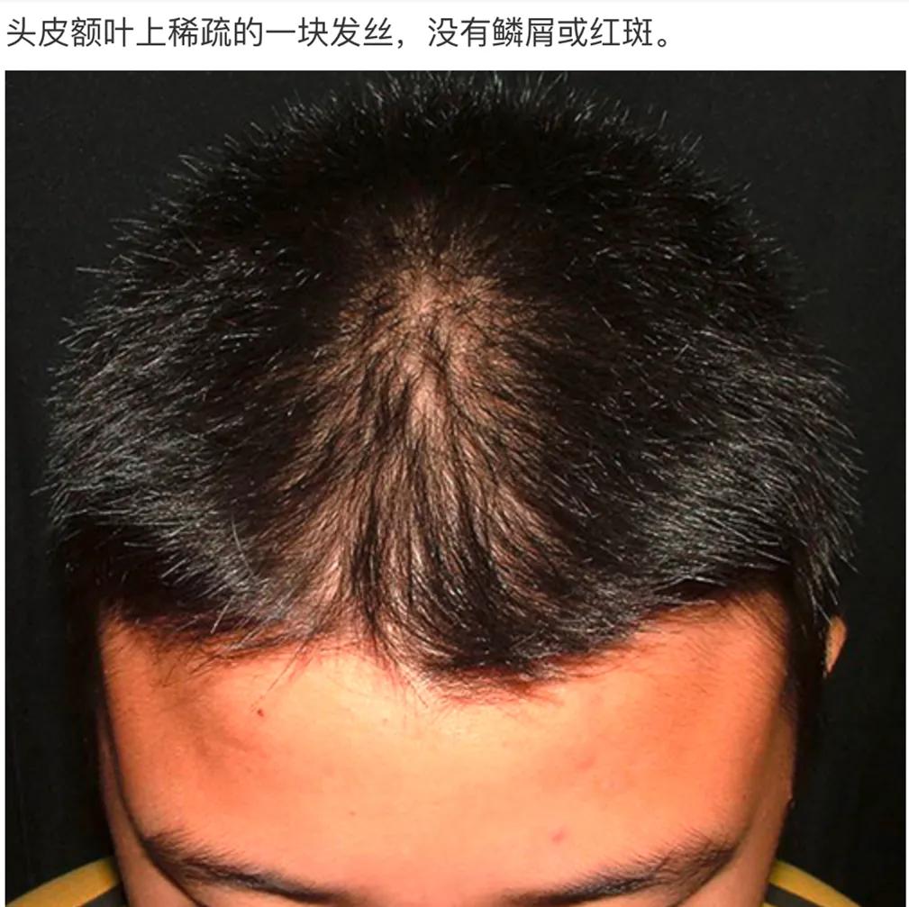 儿童脱发会是什么病的前兆,孩子毛囊引起的脱发怎么办