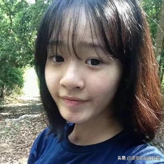 隆鼻改善蒜头鼻,蒜头鼻隆鼻一年后的真实感受