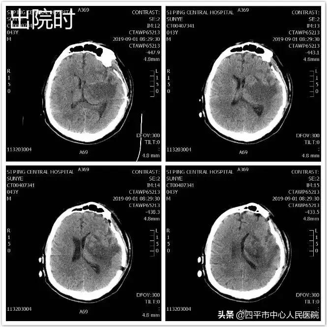精准排雷再现新高—神经外科在6月份成功救治6例颅内动脉瘤患者