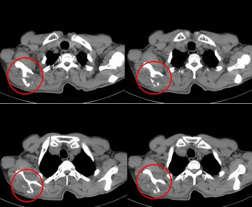 肝癌骨转移疼痛如何止痛,骨转移疼痛用什么药治疗疗效最好